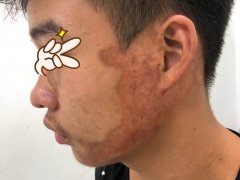 中山哪家医院治疤痕好