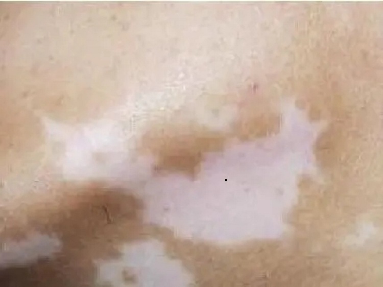 中山哪个医院的皮肤科好一点