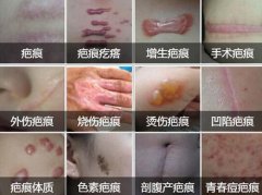 疤痕的类型是怎样的