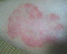 中山牛皮癣如何治疗的