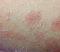 中山银屑病患者吃什么好