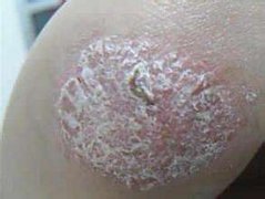 中山生活如何预防牛皮癣