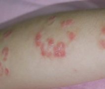 牛皮癣需要注意什么